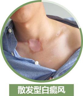 散發(fā)型白癜風(fēng)平時(shí)要注意哪些