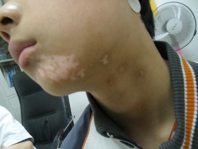 面部的白斑是不是白癜風(fēng)